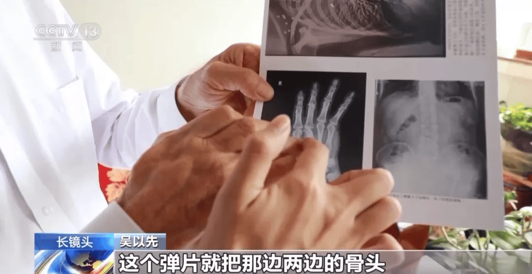 皇冠登一登二登三区别_“老先生皇冠登一登二登三区别,您把项链取下来再做CT”